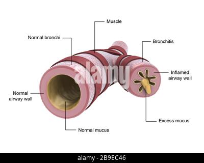 Medical illustration showing bronchitis. Stock Photo