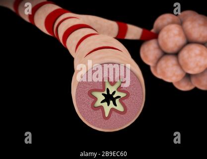 Medical illustration of an asthmatic bronchiole. Stock Photo