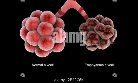 Close-up medical illustration of emphysema in the alveoli Stock Photo ...