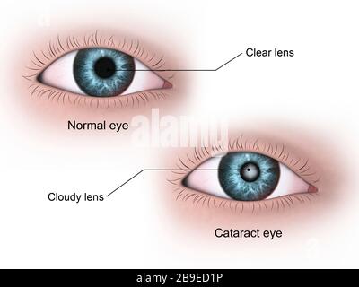 Medical illustration of a cataract in the human eye, compared to a normal eye. Stock Photo