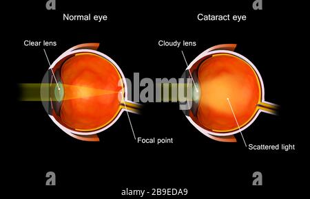 Medical illustration of a cataract in the human eye, compared to a normal eye. Stock Photo