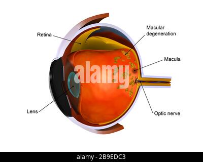 Biomedical illustration of macular degeneration. Stock Photo