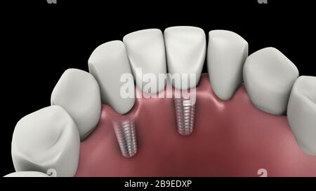 Medical illustration of a tooth implant. Stock Photo