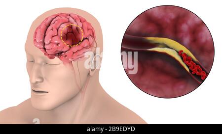 Medical illustration of an ischemic stroke. Stock Photo