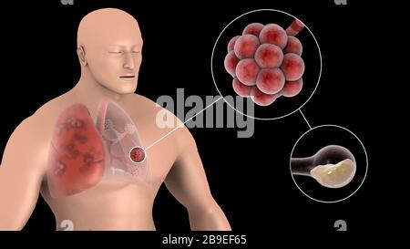 Medical illustration showing pneumonia in the alveolus of human lungs. Stock Photo