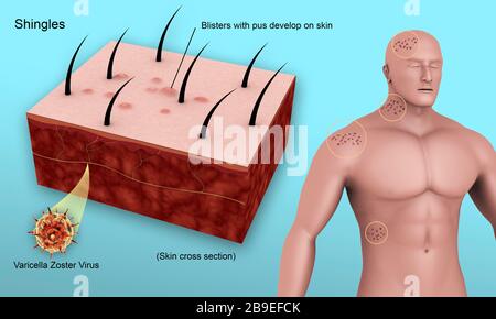 Medical diagram showing shingles caused by the varicella-zoster virus. Stock Photo