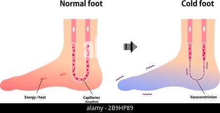 Cold Intolerance Foot Comparison illustration of normal foot and cold foot ( sensitivity to ...