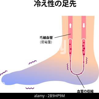 Cold Intolerance Foot Cold foot blood circulation illustration (sensitivity to cold, cold ...