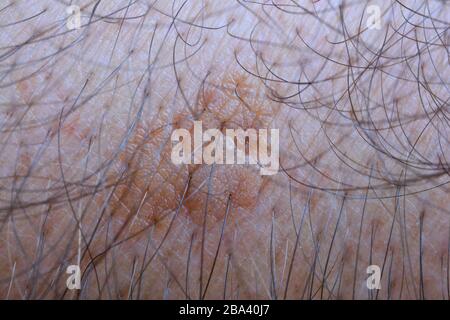 Sample of seborrheic keratosis, common non cancerous skin growth,  people tend to get more of them as they get older Stock Photo