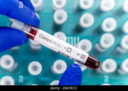 Health worker holds one test-tube and indicates positive results of corona virus test. Many blood tube-tests in special holder as a background. Stock Photo