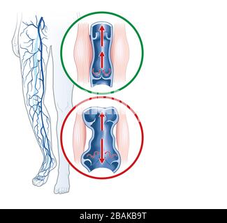 Illustration showing varicose veins and normal veins Stock Photo