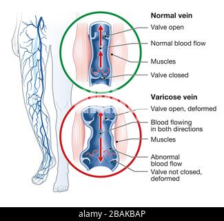 Illustration showing varicose veins and normal veins Stock Photo