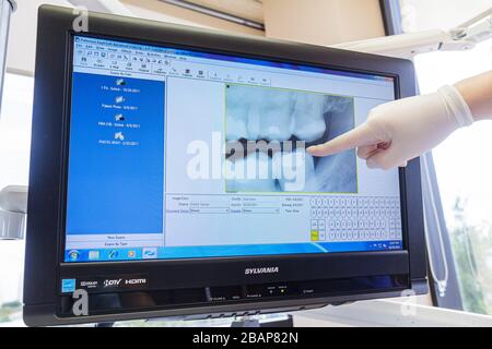 Miami Beach Florida,dentist office,digital monitor,screen,x ray,xray,tooth,teeth,filling,hand,hands,finger,pointing latex glove,technician,explaining, Stock Photo