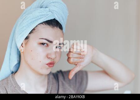 Scowling girl in shock of her acne with a towel on her head. Woman skin care concept photos of ugly problem skin girl Stock Photo