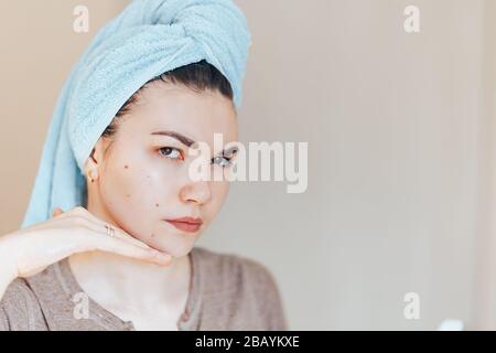 Scowling girl in shock of her acne with a towel on her head. Woman skin care concept photos of ugly problem skin girl Stock Photo