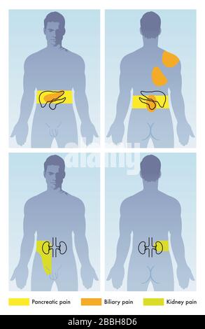 Medical illustration of male figure with localized pancreatic, biliary and kidney pains. Stock Vector