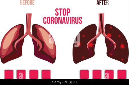 Human lungs before and after Coronavirus cell spread in human lungs, coronavirus. Stock Vector