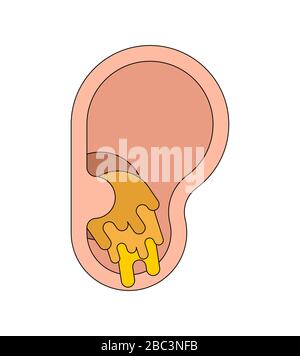 Ear plug Earwax in ear isolated. cerumen vector illustration Stock Vector