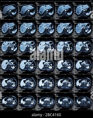 MRI scan of the Human Abdomen organs Stock Photo - Alamy