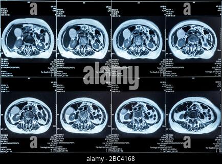 MRI scan of the human chest and abdomen, transverse view. Well ...