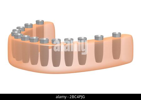 Teeth implants/ dental implants Stock Photo