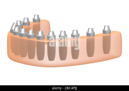 Teeth implants/ dental implants Stock Photo