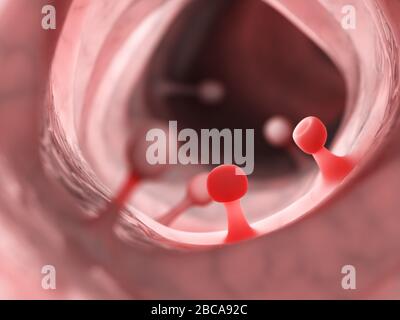 Colon polyps, illustration. Stock Photo