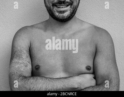 Man with arm fire scar smiling in front of camera - Black and white editing - Focus on body - on the left arm man have the skin with burns Stock Photo