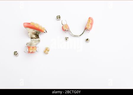 removable clasp prosthesis on the upper and lower jaw with metal and ceramic-metal crowns Stock Photo