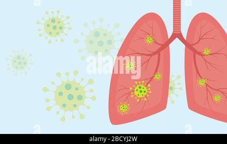 Virus cells in lung. Infected lungs. Coronavirus, COVID-19. 2019-nCoV. lung disease, pneumonia, asthma, cancer, tuberculosis. Stock Vector
