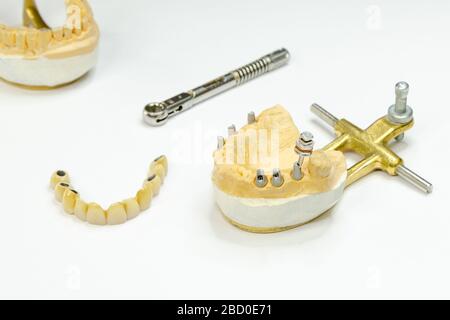 artificial teeth on implants. jaw model with dental implants. a screwdriver is inserted into the abutment. the key is next Stock Photo