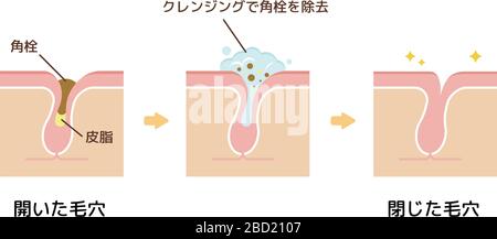 Structure illustration of pores / Clear keratotic plug (whiteheads ,blackheads ) with cleansing. Stock Vector