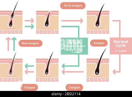 Comparative illustration of normal hair cycle and AGA ( androgenetic ...