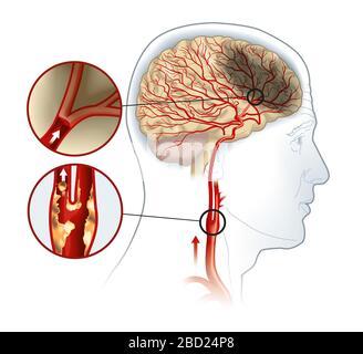 Illustration showing plaque in carotid artery, blood clot breaking off and blocking blood flow Stock Photo