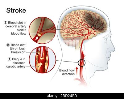 Illustration showing plaque in carotid artery, blood clot breaking off and blocking blood flow Stock Photo