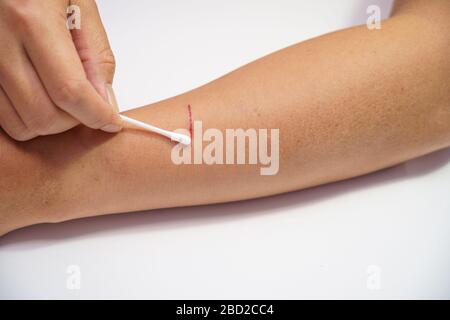 Close up Men's arms hand, upper limb or arm to the wounded blood and  lesion, slit waiting for nurse treatment on clean the wound dressing a  bloody, pa Stock Photo - Alamy