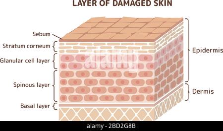 Layer of damaged skin illustration Stock Vector Image & Art - Alamy