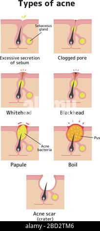 Types of acne illustration set (skin care) Stock Vector