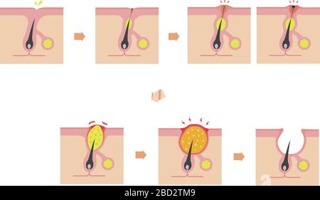 Acne types and progression illustration Stock Vector