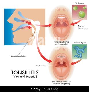 tonsil crypt anatomy