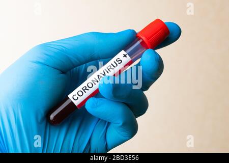 Hand in glove hold positive blood test result for the new rapidly spreading Coronavirus, Stock Photo