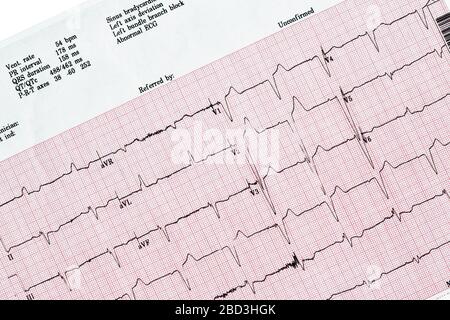 Close Up of Ecocardiography report (ECG) showing irregular heartbeat Stock Photo