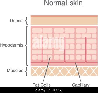 skin with cellulite and normal skin cross-section of human skin layers ...