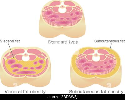 Type of obesity illustration . Abdominal sectional View (subcutaneous ...