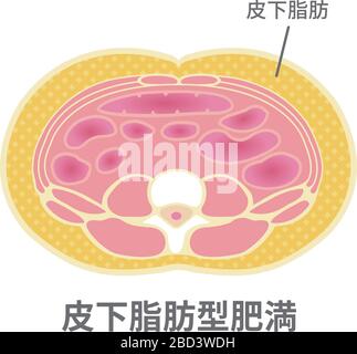 Type of obesity illustration. Abdominal sectional View. (visceral fat ...