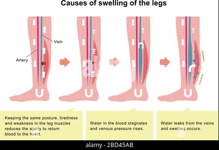 Cause of swelling (edema) of the legs. flat illustration Stock Vector