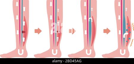 Cause of swelling (edema) of the legs. flat illustration Stock Vector