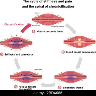 Cycle of stiffness and pain , and spiral of chronicification ...