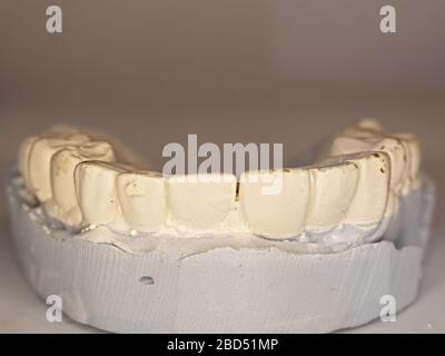 Plaster cast of teeth of removable partial denture Stock Photo