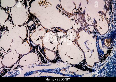 Charcoal dust lung tissue under the microscope 100x Stock Photo